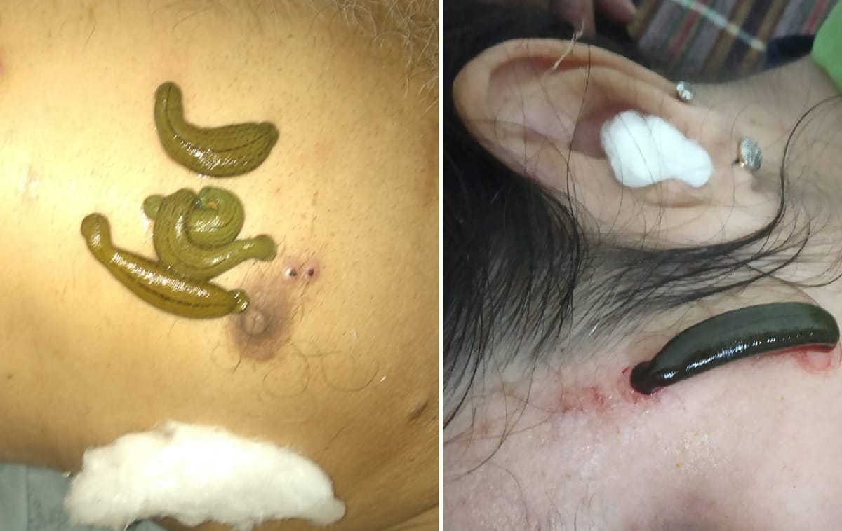 Leech Therapy : गैंगरीन, माइग्रेन, नसों की तकलीफ को दूर करने में आती है काम, आयुर्वेद तरीके से किया जाता है ईलाज