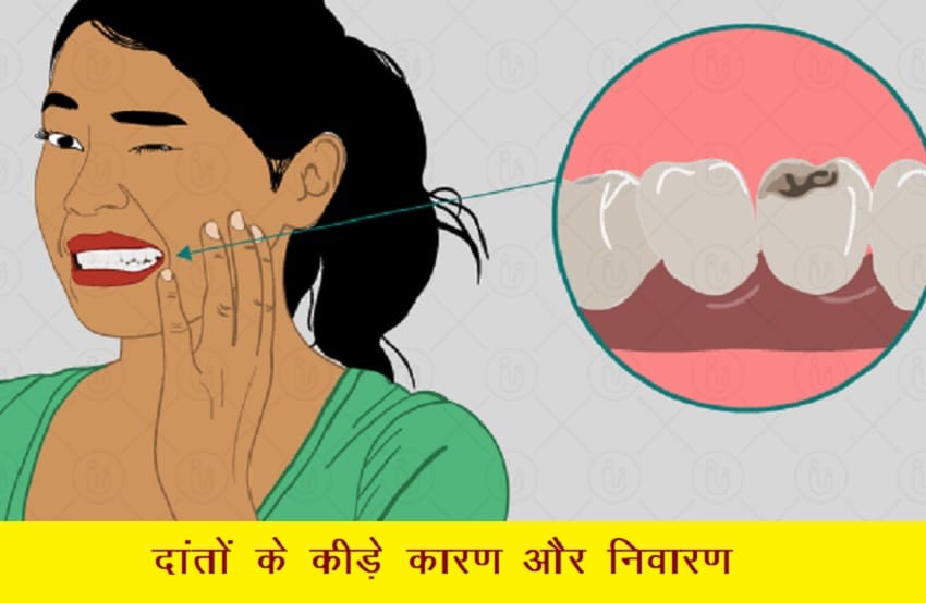 Teeth Care : क्यों गलने लगते दांत, क्या है कीड़े पड़ने का कारण, विशेषज्ञ चिकित्सक से जानिए बचाव का तरीका