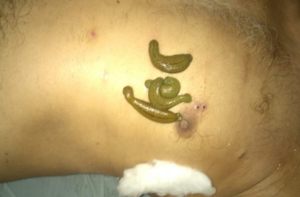 
Leech Therapy : गैंगरीन, माइग्रेन, नसों की तकलीफ को दूर करने में आती है काम, आयुर्वेद तरीके से किया जाता है ईलाज
