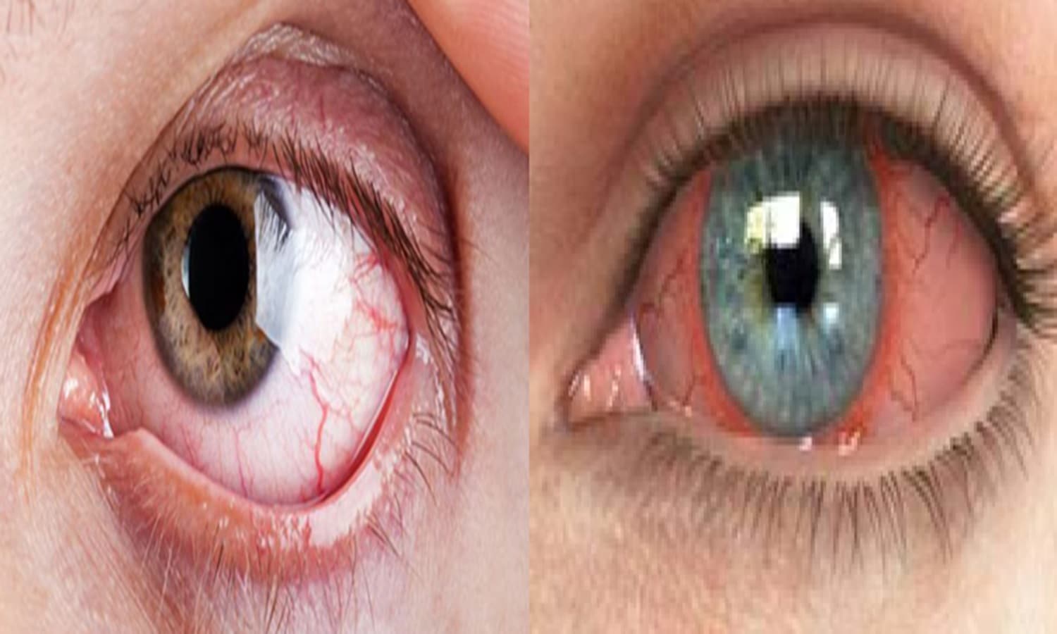 Diabetic Ratinopathy : डायबिटीज के मरीजों को बना रहता हैं आंख की रोशनी जाने का खतरा, क्या है इसका कारण