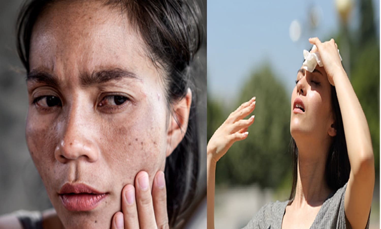 Suntain Skin Problems In Hindi : सनटैन की वजह से स्किन हो जाती है काली और बेजान, जानिए क्या है इसका उपचार